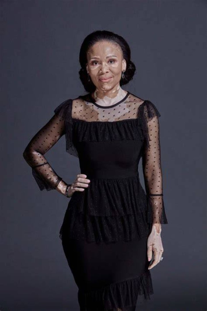 Leleti Khumalo talks about how she learned to accept her skin condition